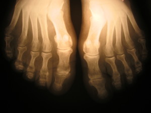 x-ray-foot-1435088-1280x960